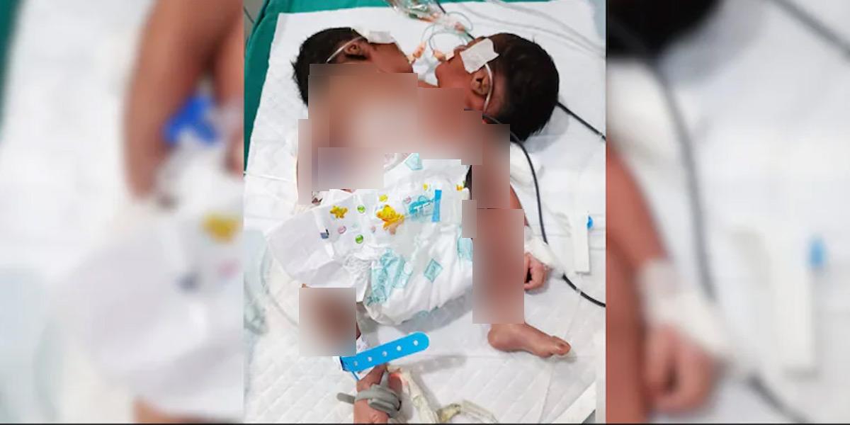 দুটি মাথাযুক্ত শিশুর জন্ম, প্রতি ৩ লাখে ঘটে একটি